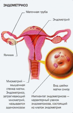 Эндомитоз у женщины. Эндометриоз стенки матки. Женское заболевание эндометриоз.